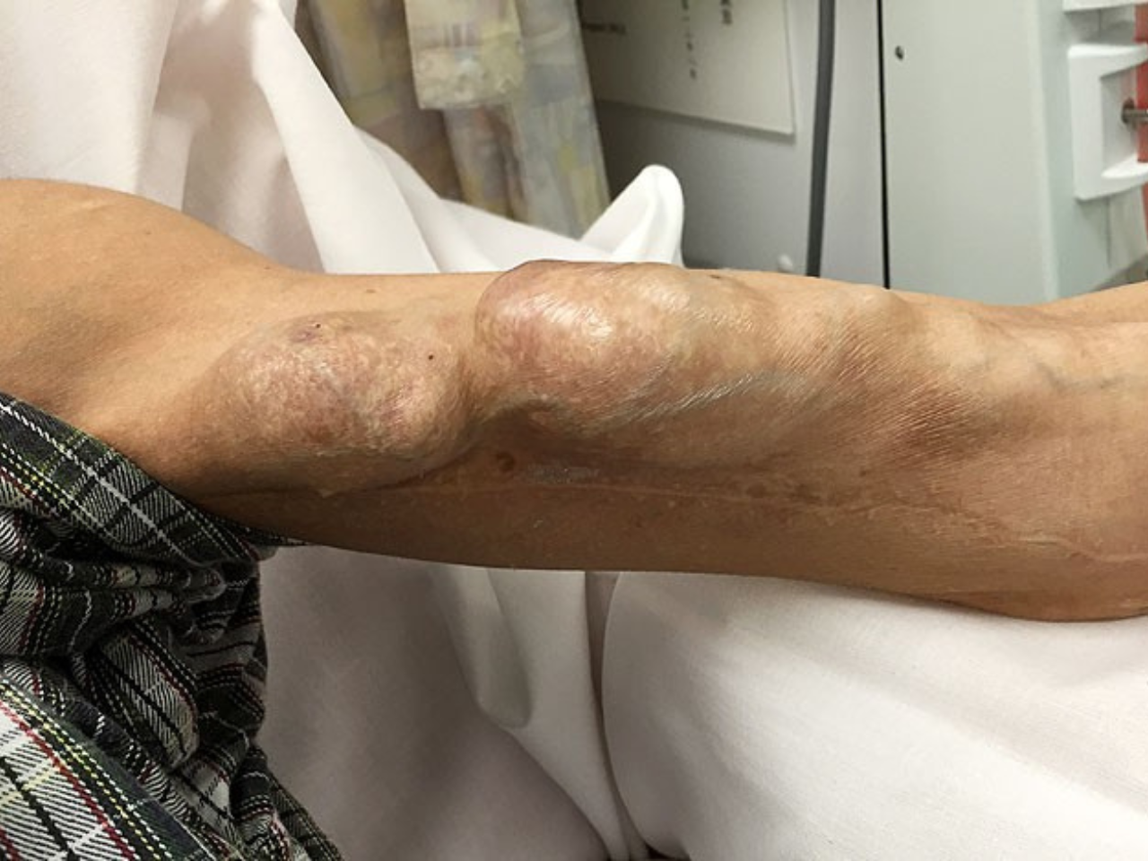 AV Fistula for Dialysis