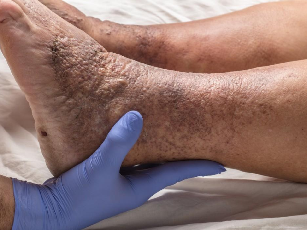 Deep Veins Thrombosis