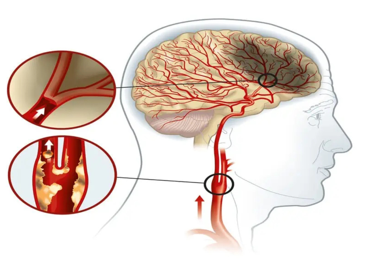 Carotid Artery Diseases