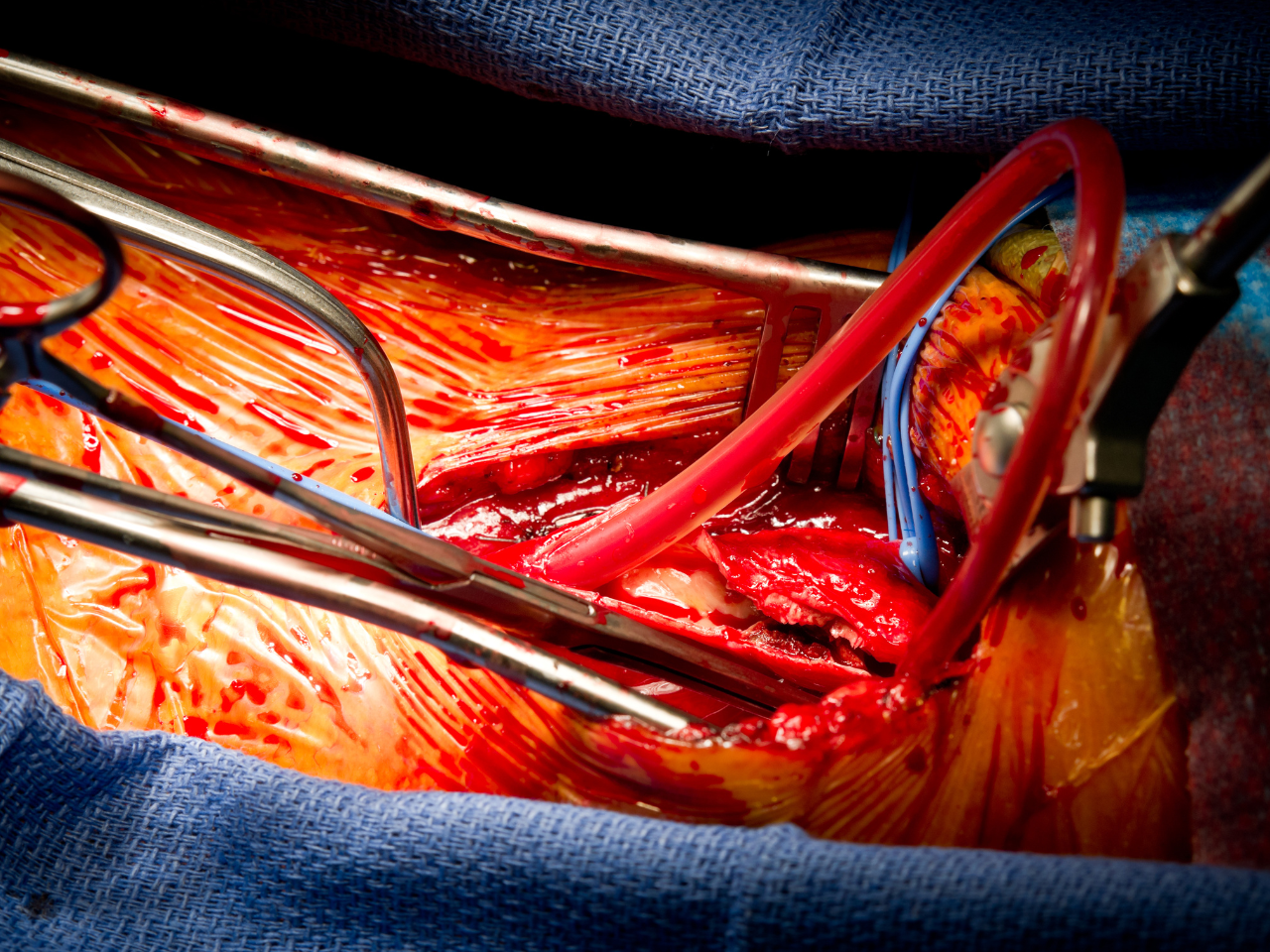 What is Vascular Surgery?