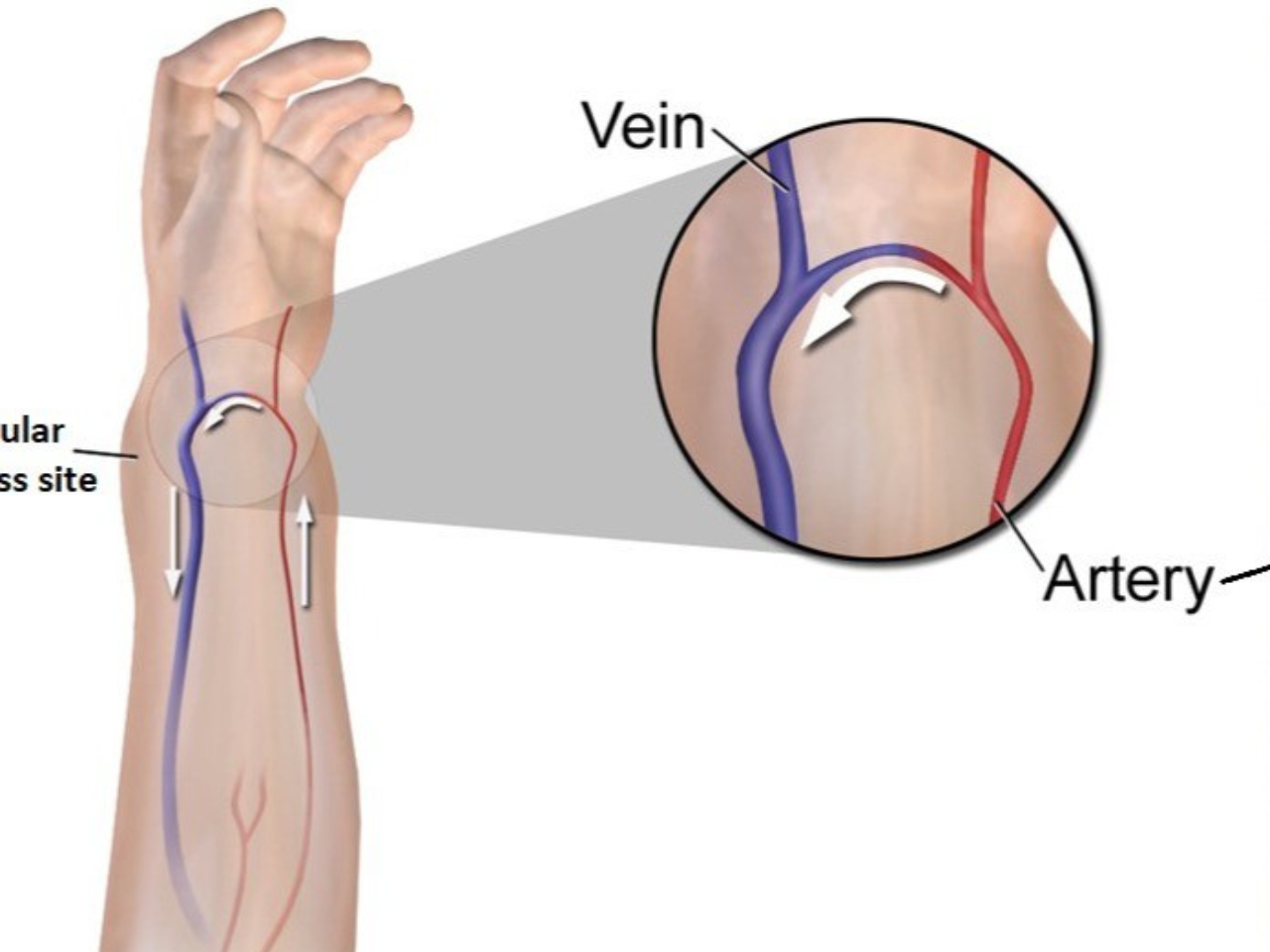 AV Fistula for Dialysis