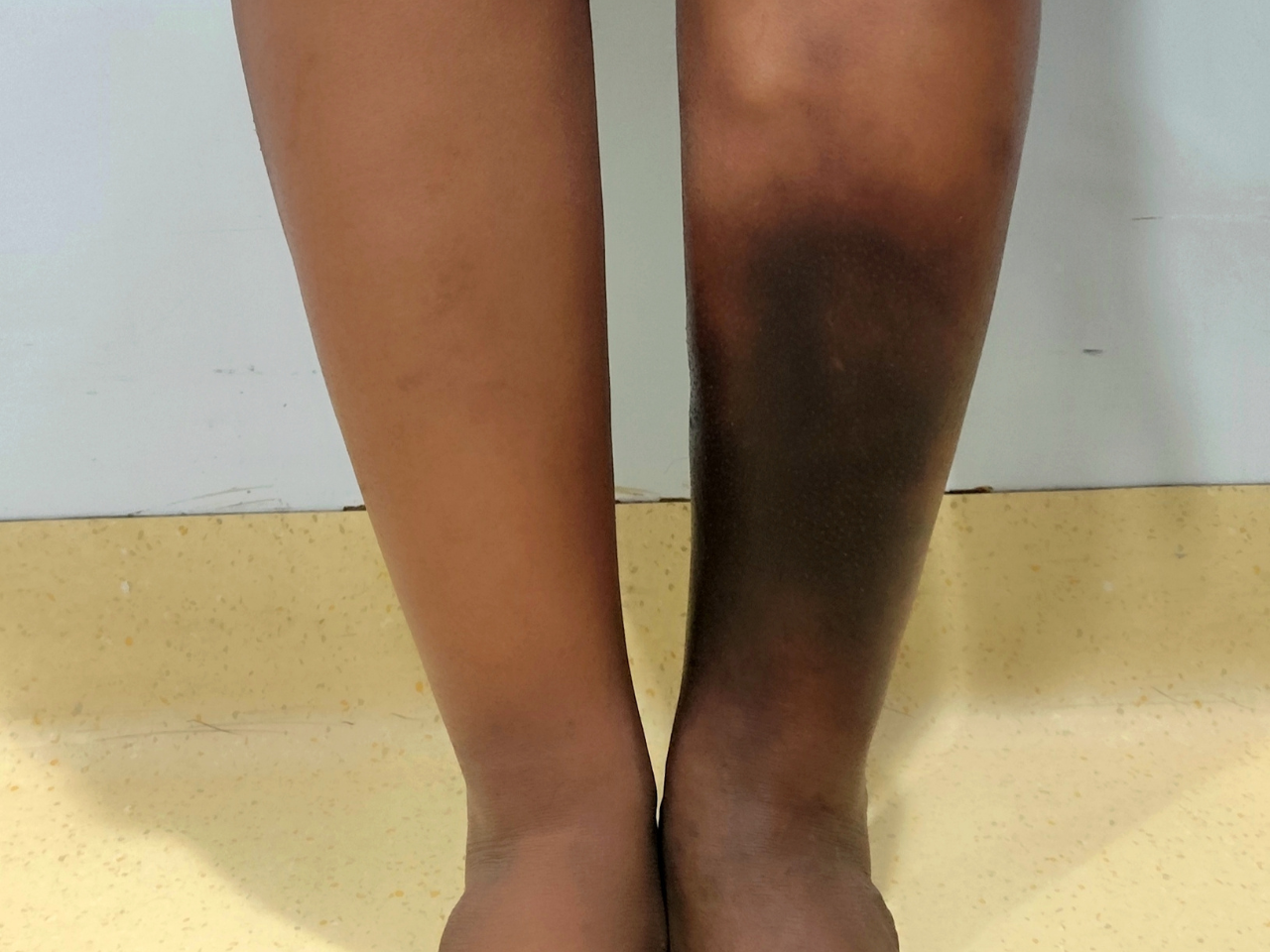 Deep Vein Thrombosis: Basics and Beyond!
