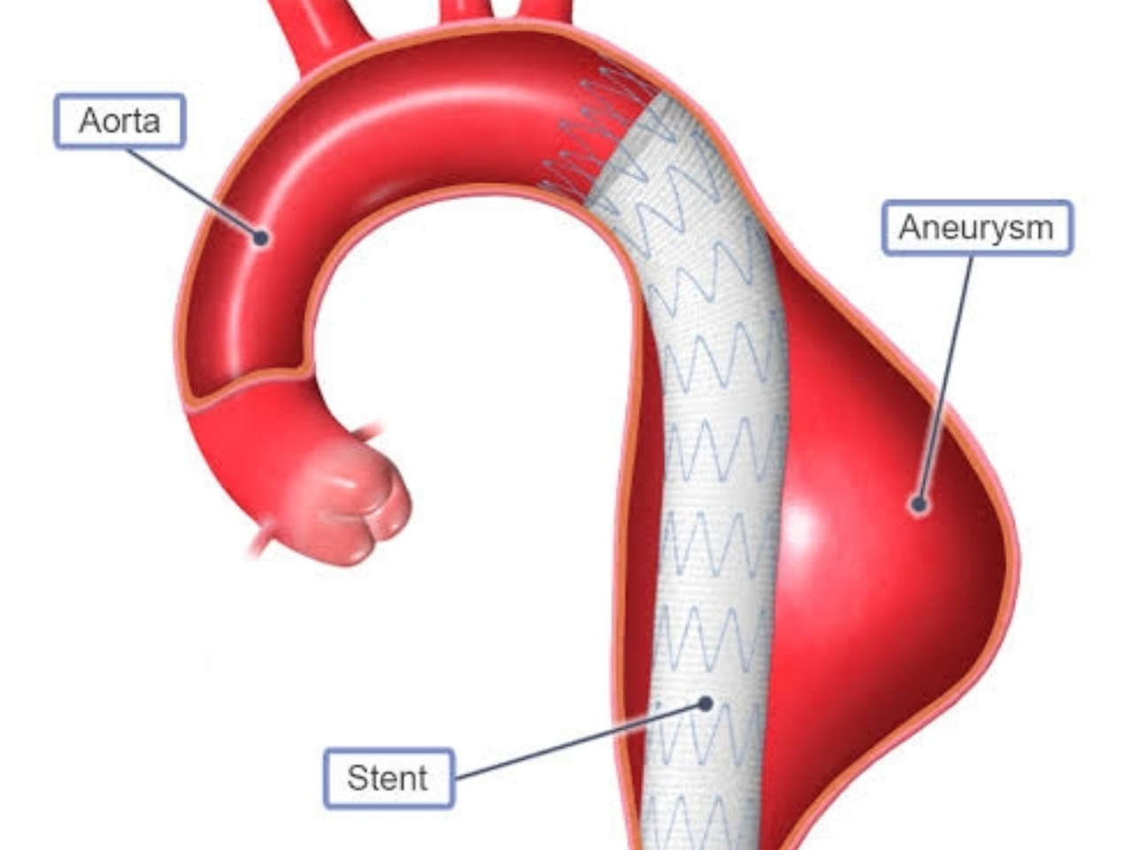 Arterial Aneurysms