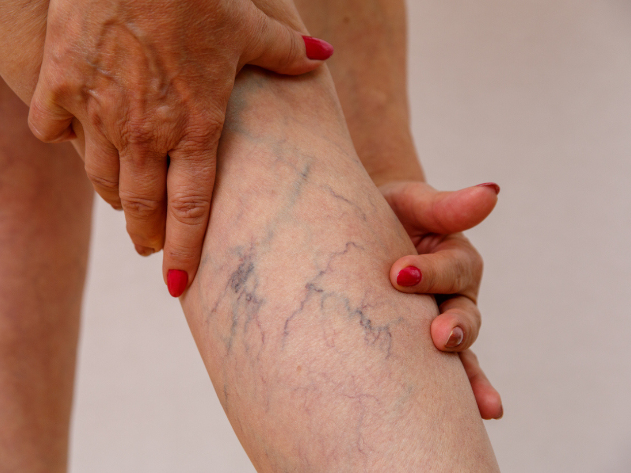 Veins on Legs