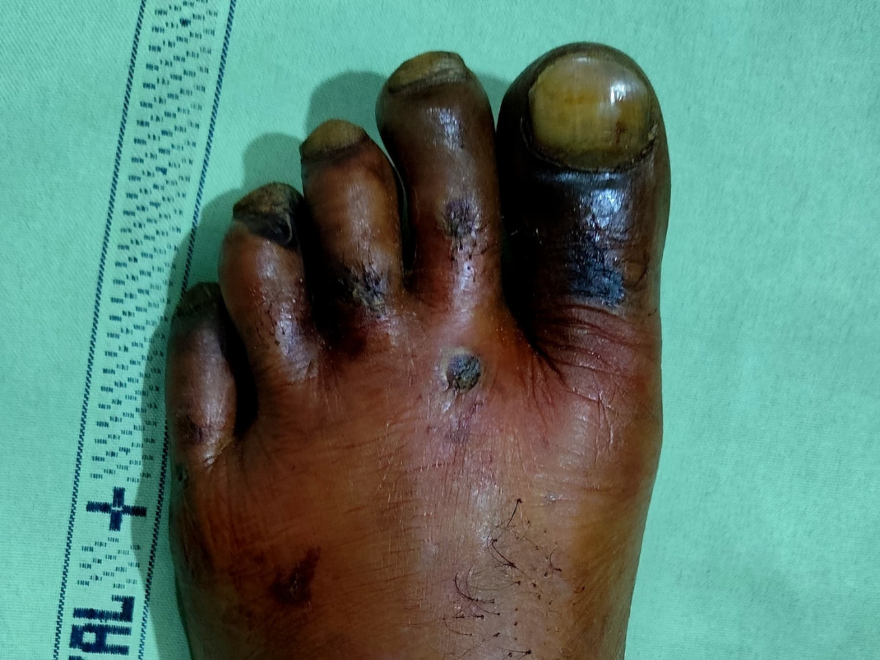 Diabetic Foot or Gangrene