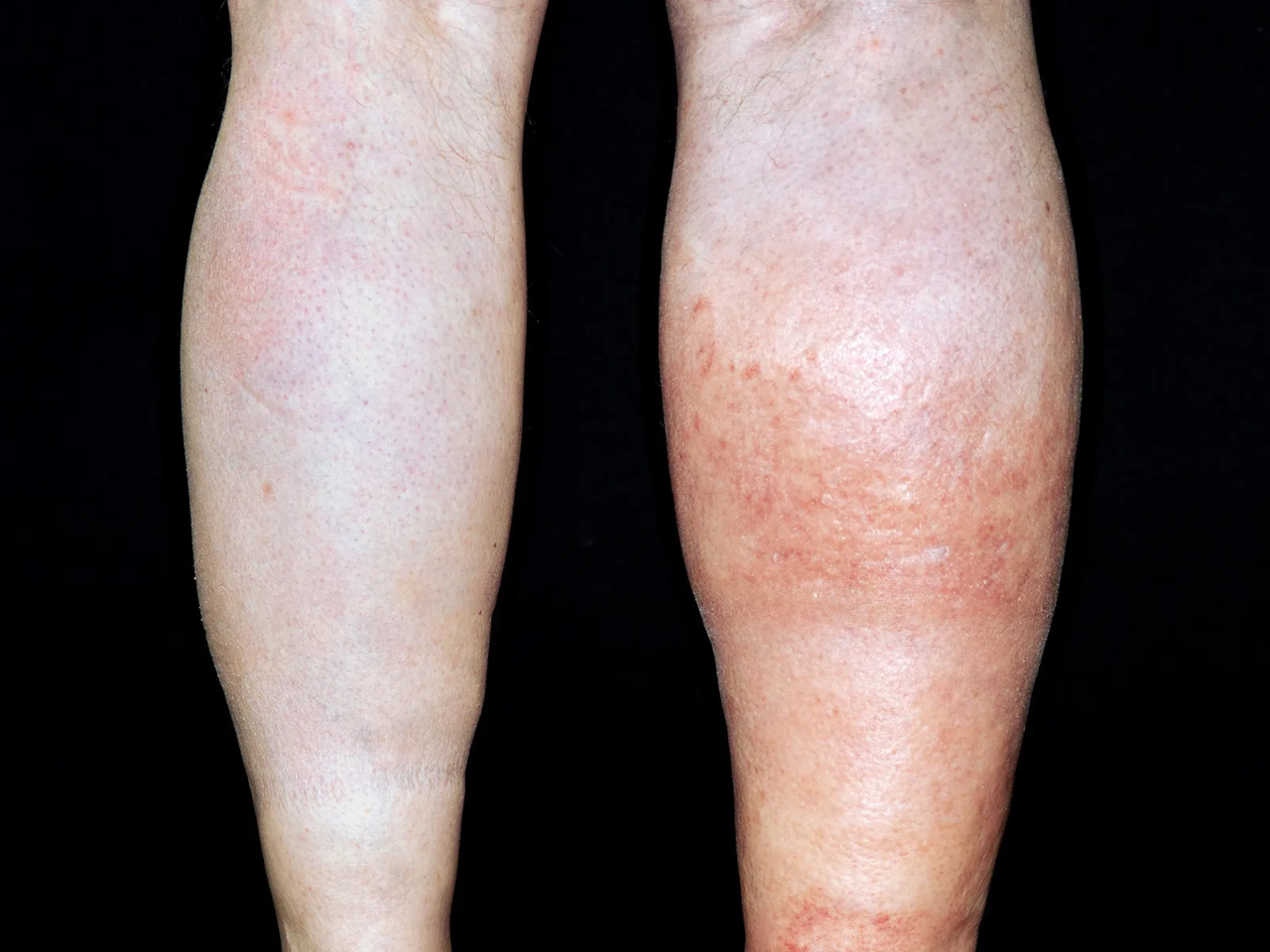 Clot in Arms or Legs