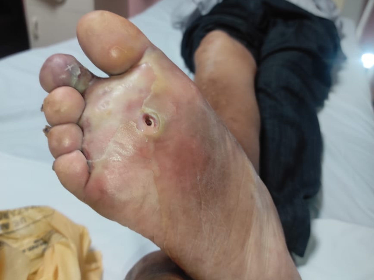 Non-Healing Ulcer on Foot