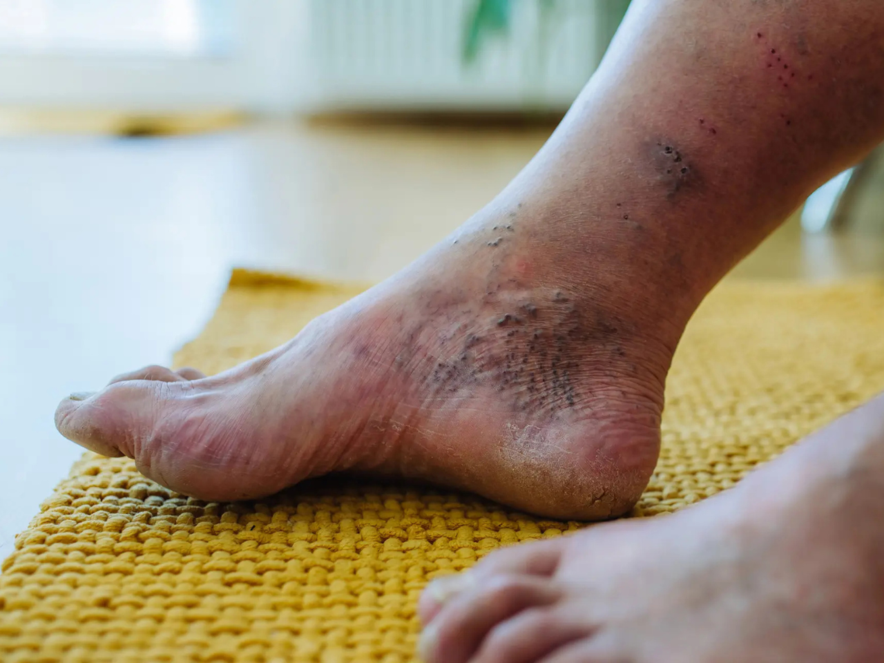 Varicose Veins