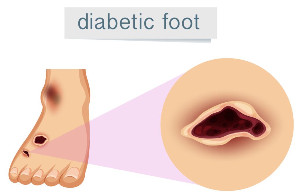 Poor circulation leads to non-healing foot ulcers