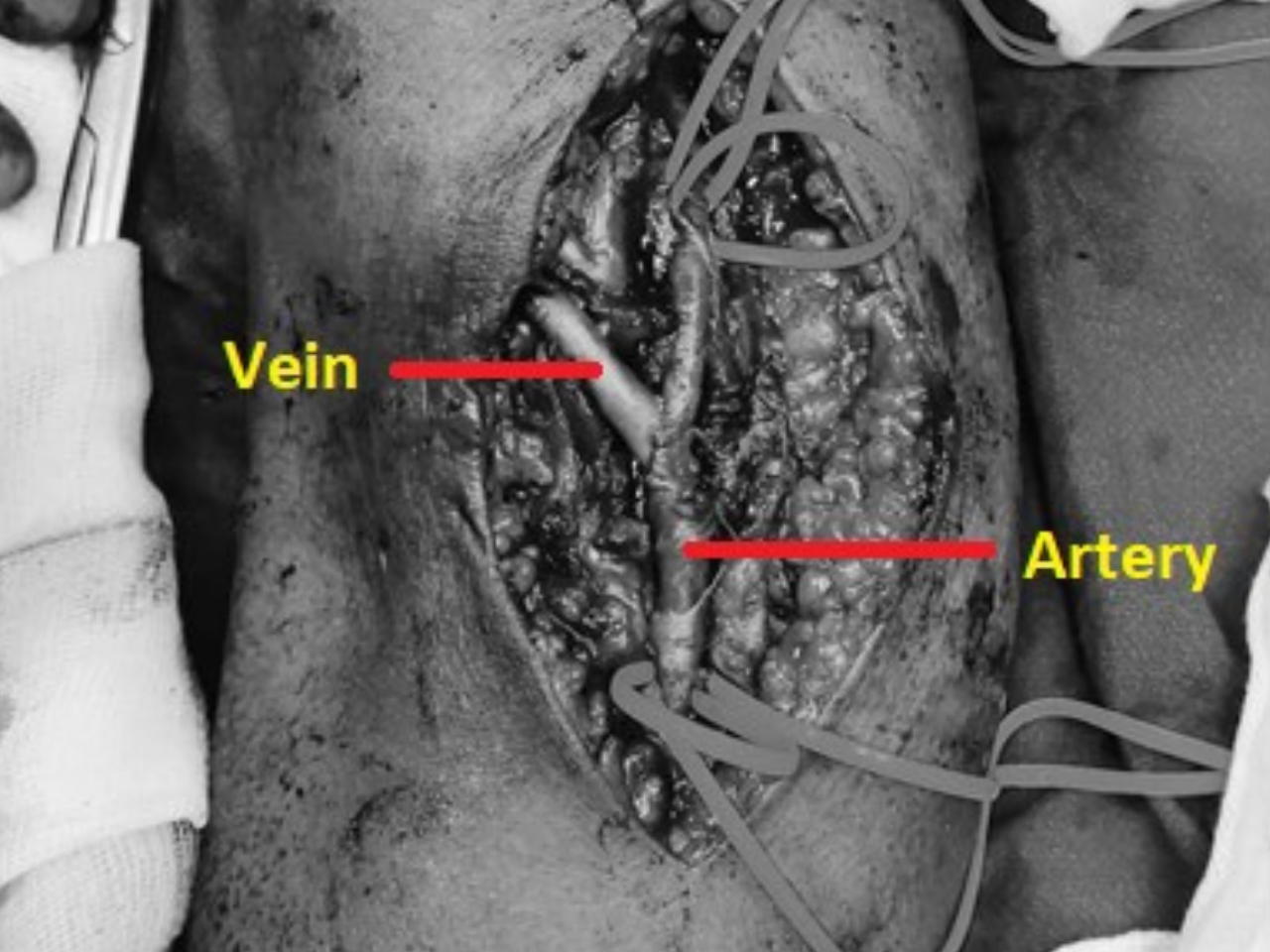 AV Fistula for Dialysis