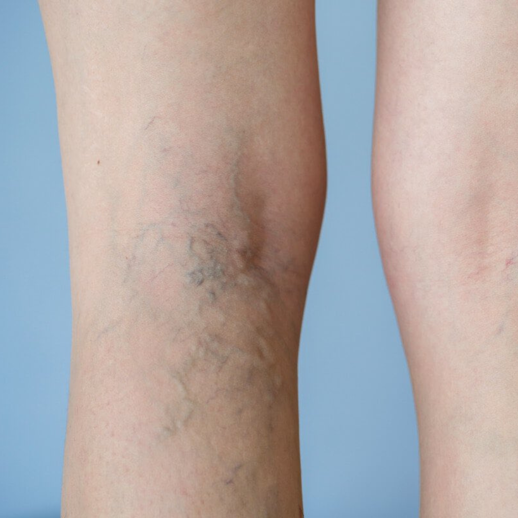 Varicose veins - commonest vascular disease