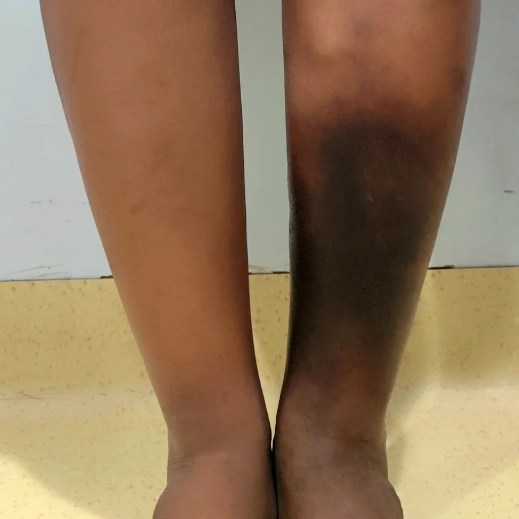 Sudden clot in leg or acute DVT