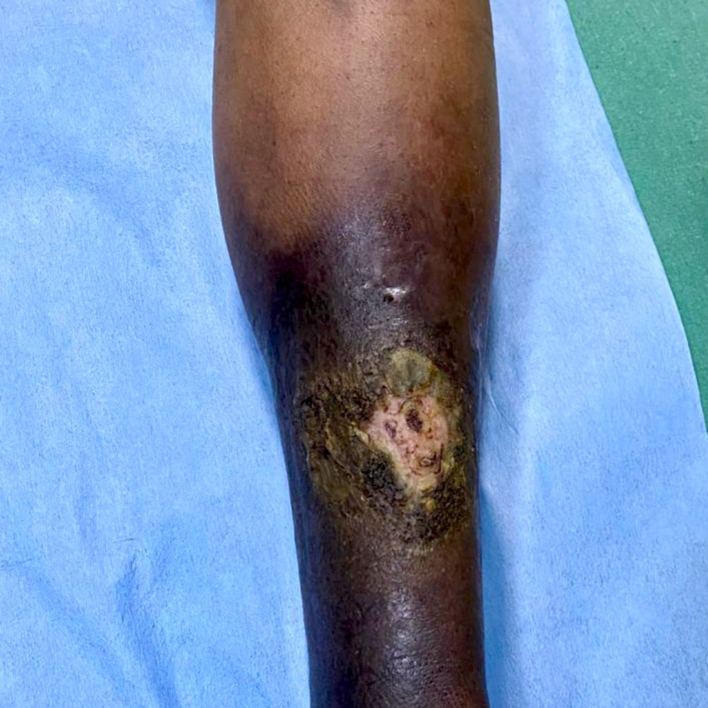 Long-standing clot in leg or Chronic DVT