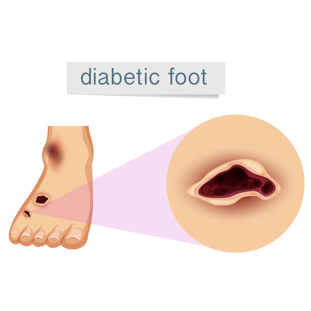 Non healing ulcer in foot - more than 1 month