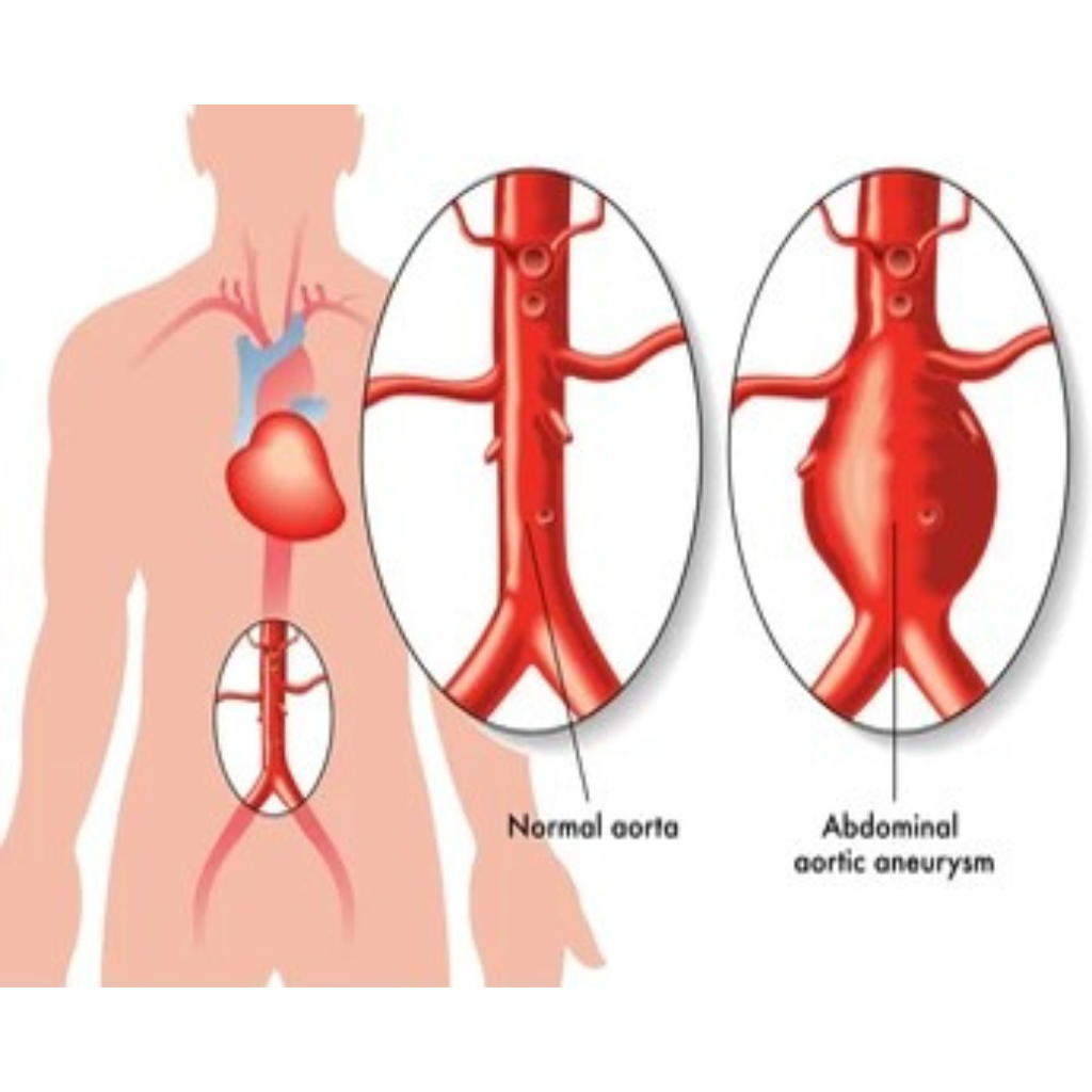 Dangerous bulge at a weak area in the artery wall