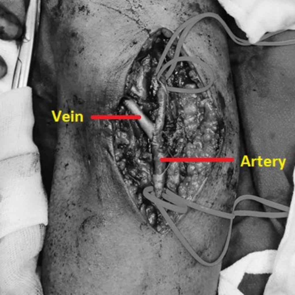 AV Fistula for Dialysis