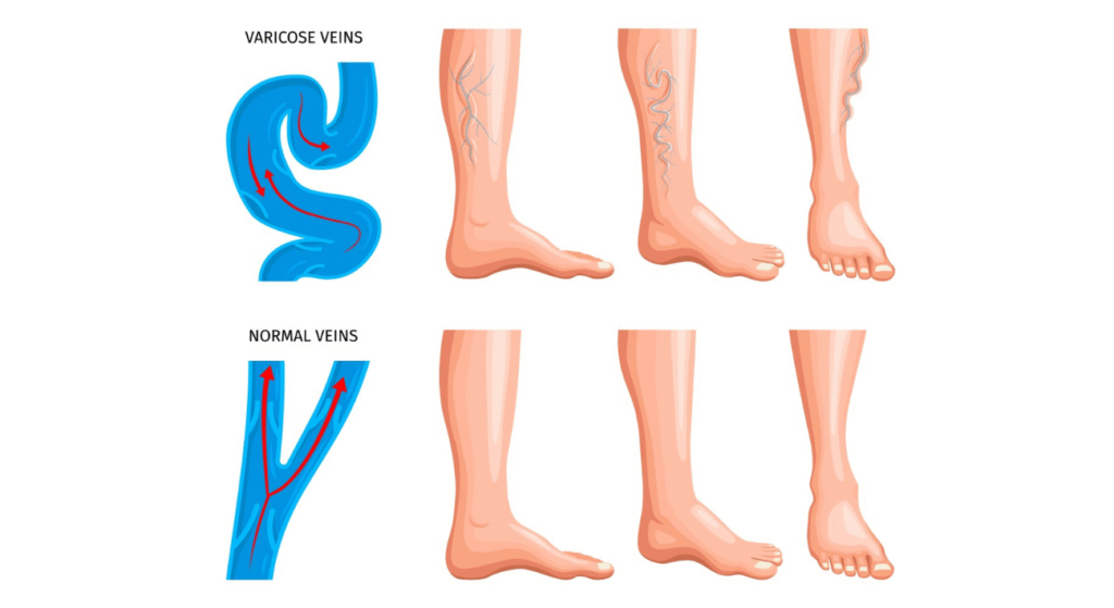 Varicose veins in leg