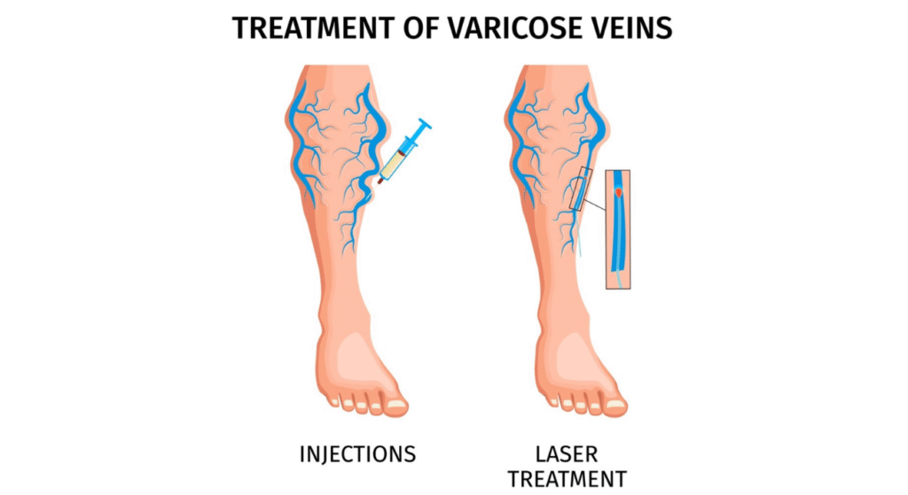 Sclerotherapy (injection) vs Laser treatment for varicose veins