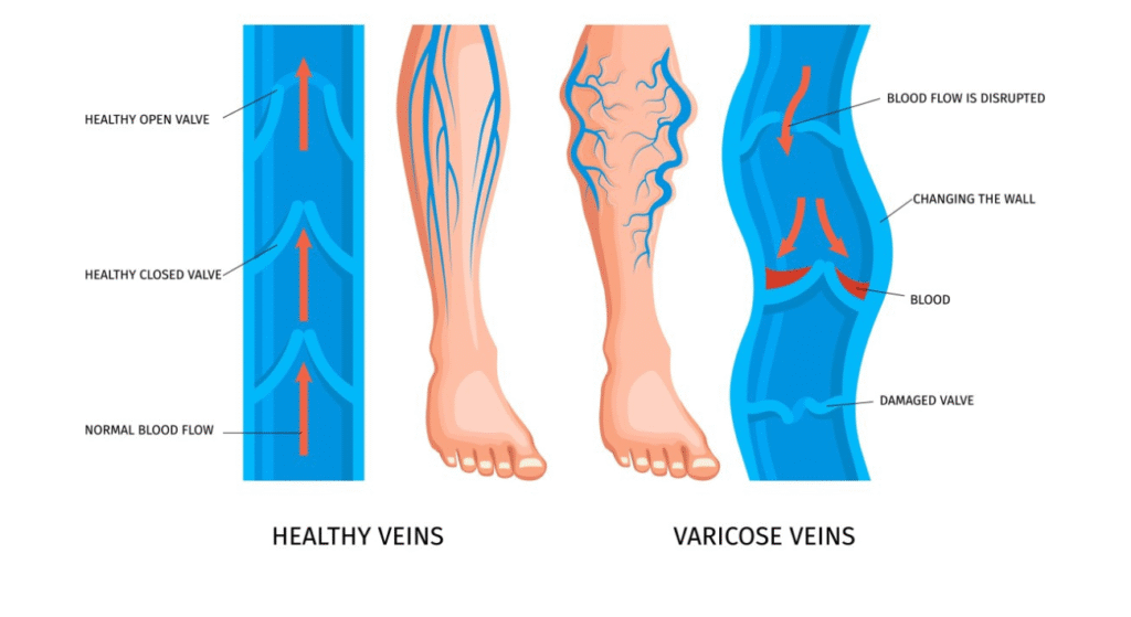 What Are Varicose Veins?