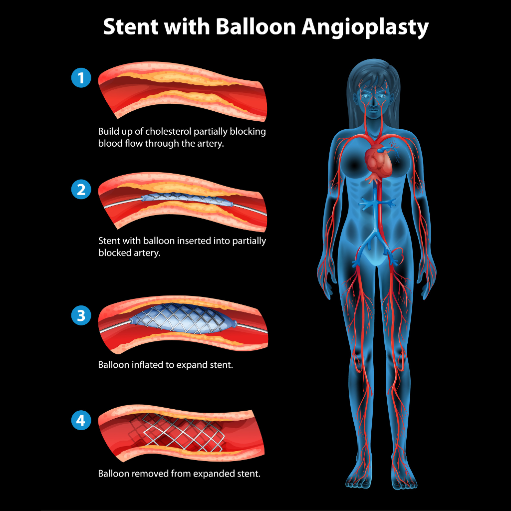 A small balloon is used to open narrowed arteries and improve blood flow
